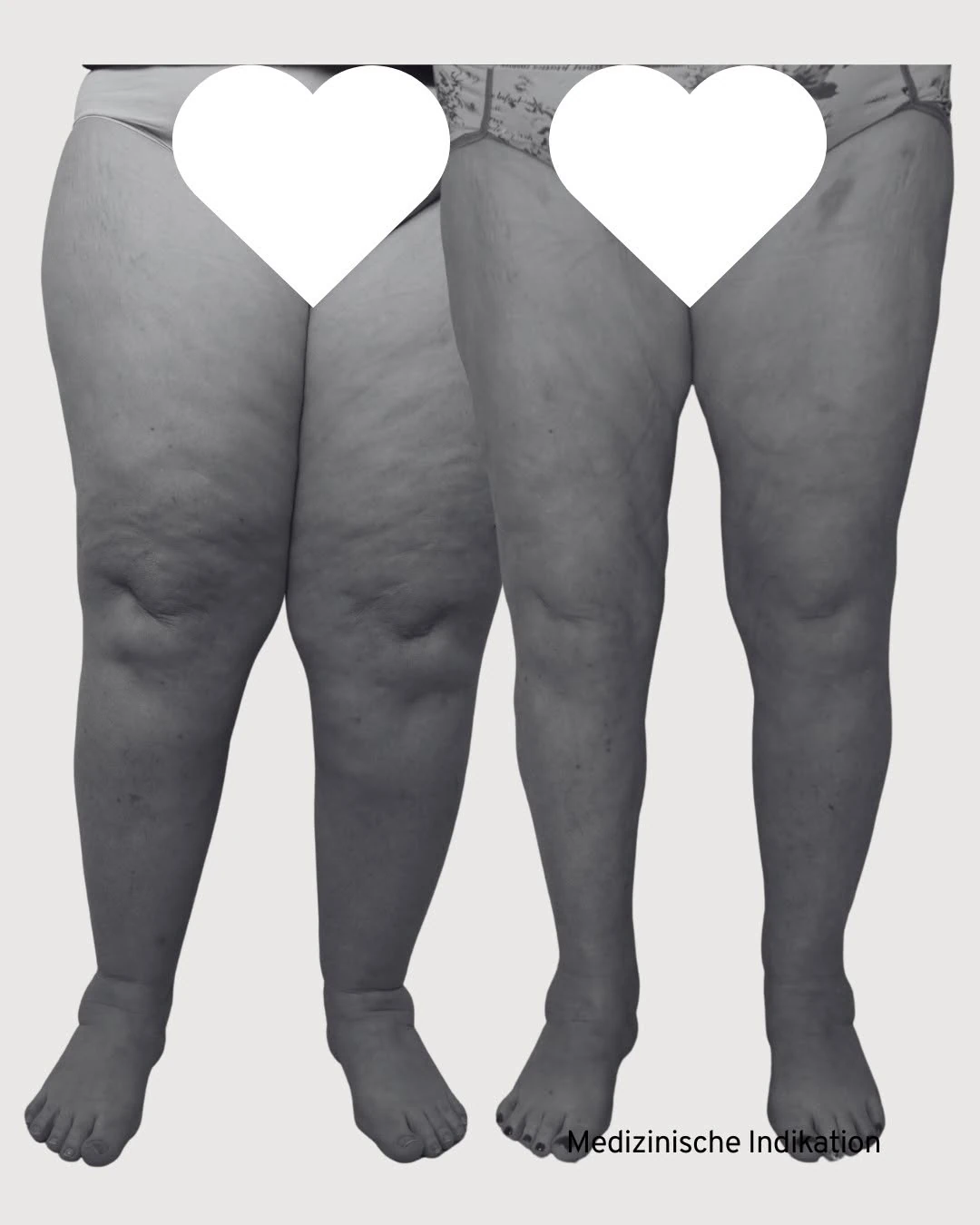 Beine einer Patientin mit Lipödem Stadium II, links vor und rechts sechs Monate nach der zweiten Liposuktion, Ansicht von vorn