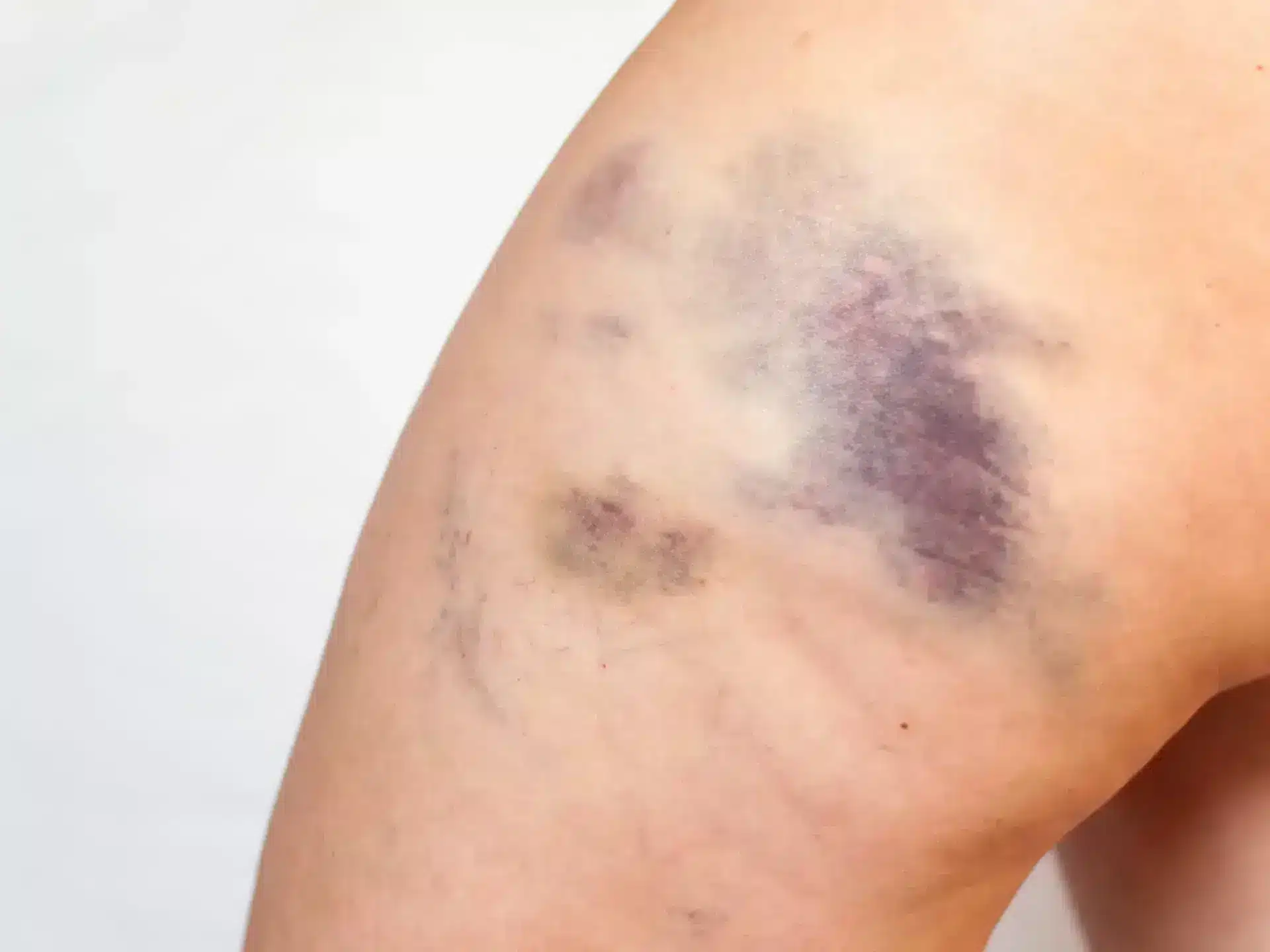 Piel con moratones violáceos y amarillentos sobre fondo blanco, imagen simbólica sobre los moratones sin motivo aparente en BONITAS Núremberg