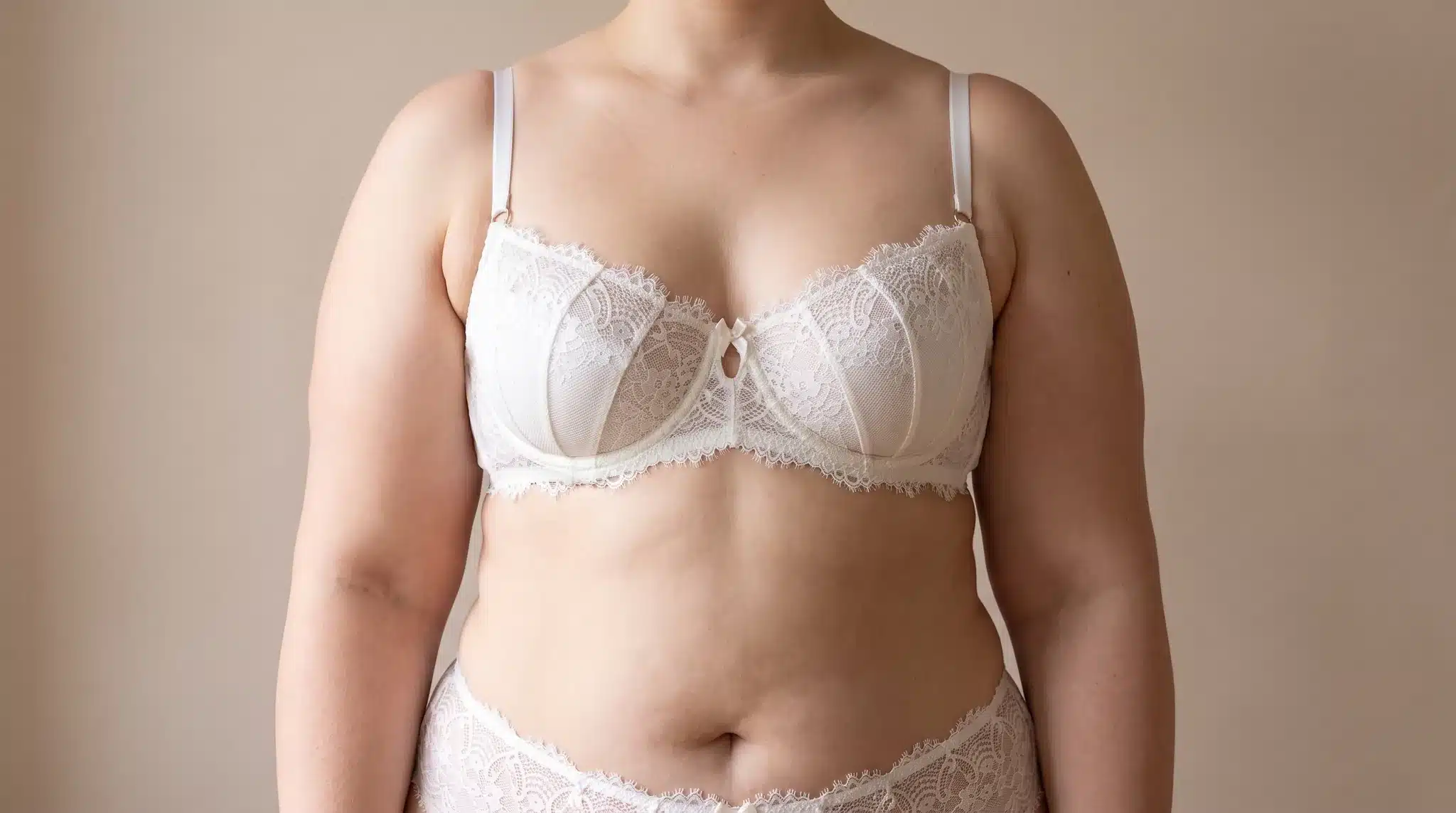 Oberkörper einer Frau mit deutlich verdickten Oberarmen, in cremefarbener Spitzenwäsche, Symbolbild zum Thema Lipödem an den Oberarmen bei BONITAS in Nürnberg